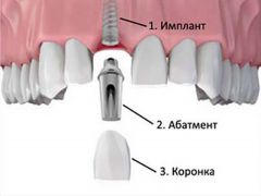 Зубы новые как свои стоматология иплантация 