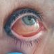 В Чувашии женщина после татуажа век получила химический ожог глаза